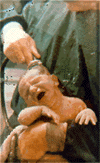 Birth Injury